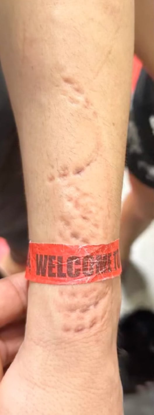 Una luchadora mostró cómo le quedó el brazo tras sufrir múltiples mordeduras de su rival durante el combate: “Dejaré que las marcas hablen”