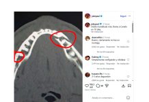 La impactante imagen que subió Jake Paul tras confesar que Anthony Joshua le rompió la mandíbula durante la pelea