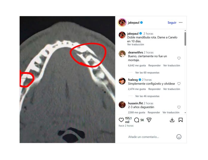 La impactante imagen que subió Jake Paul tras confesar que Anthony Joshua le rompió la mandíbula durante la pelea